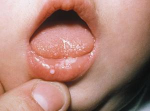 Почему у малыша в уголках рта появляются «заеды»